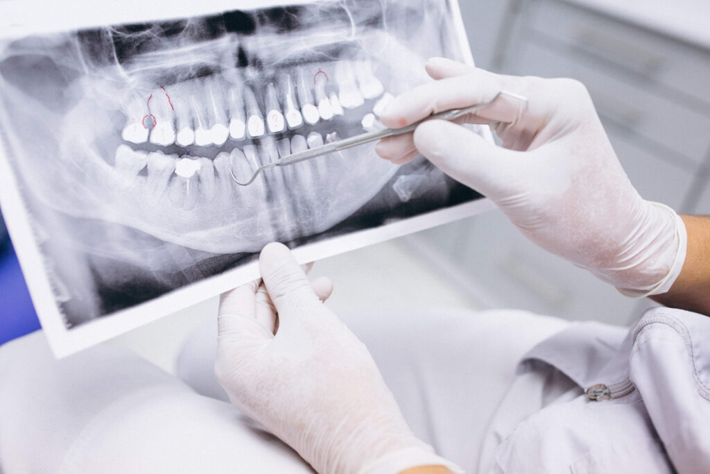 X ray of teeth
