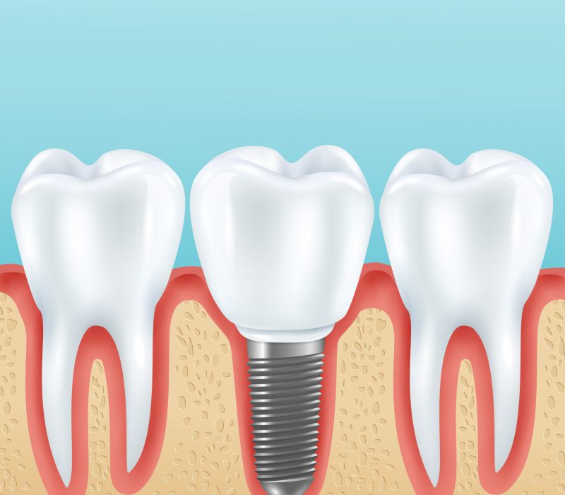 dental implant realistic illustration