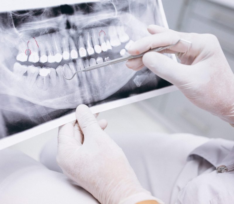 X ray of teeth