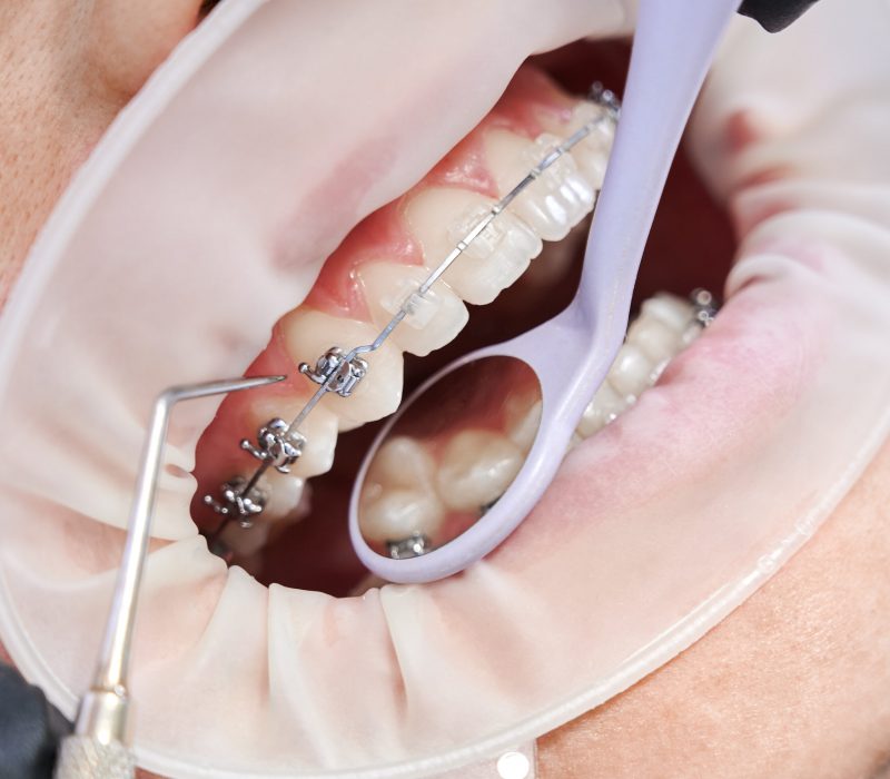 Dentist attaching metal braces to patient teeth.