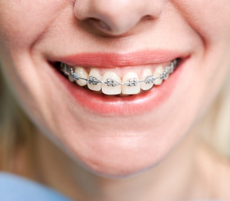 Smiling young woman with braces on teeth.